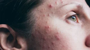 acne-2