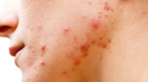 acne-3