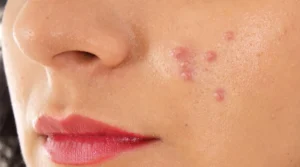 blemishes-2