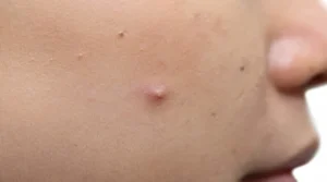 blemishes-3